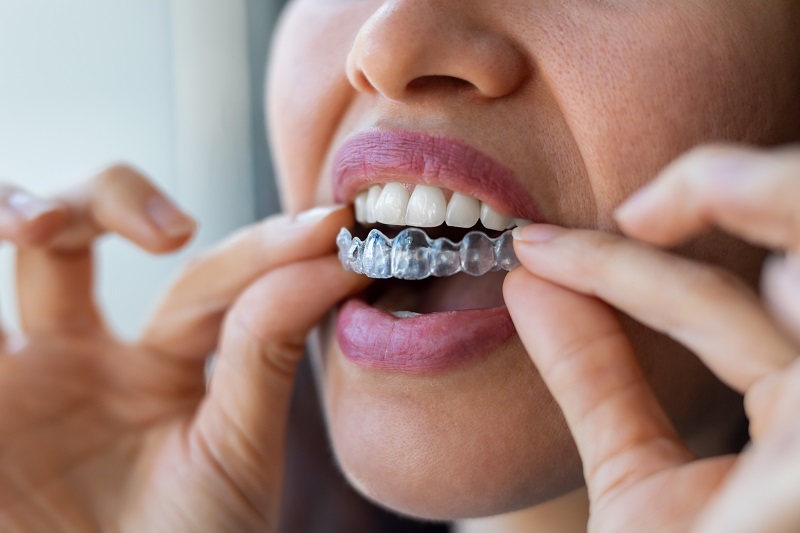 clear aligner example