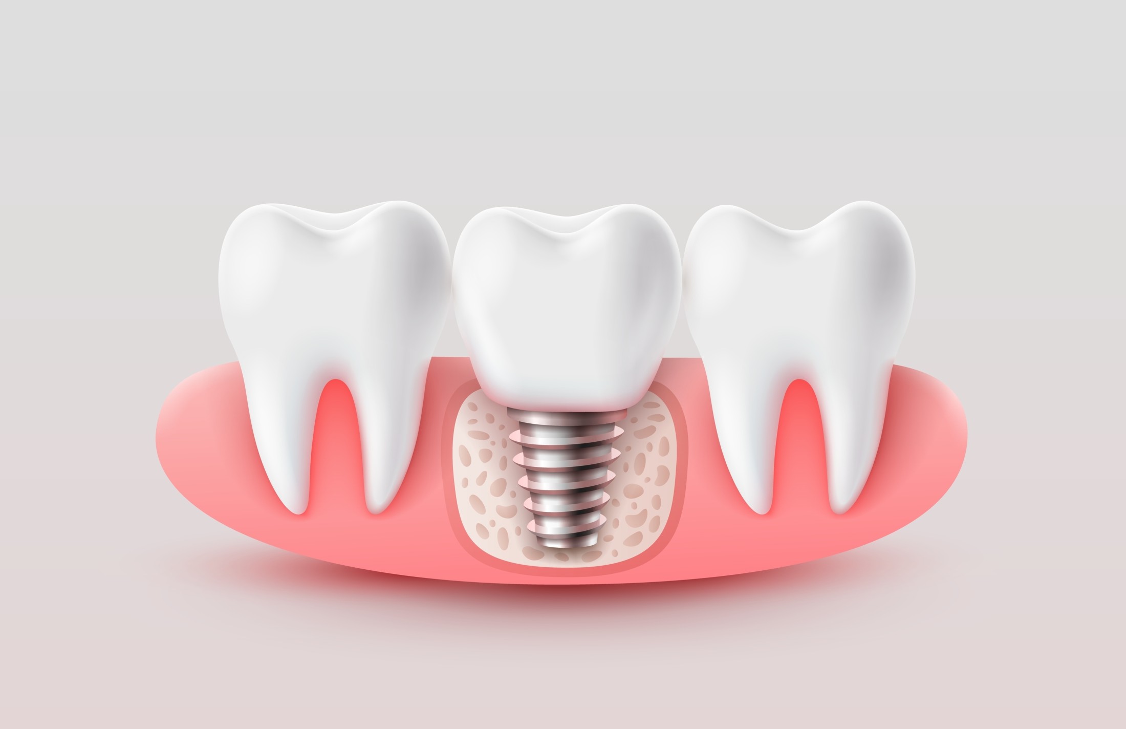 dental implant animation