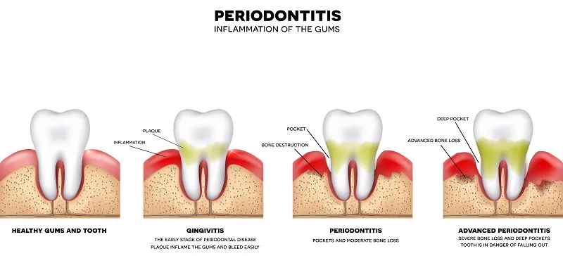 animation of gum disease treatment