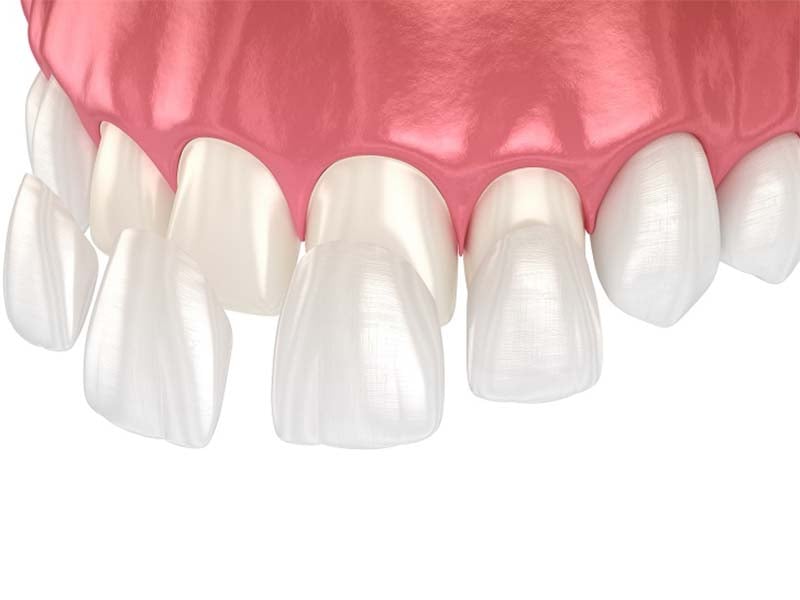 animation of top row veneers
