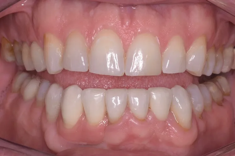 Implant Crown After
